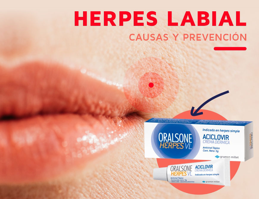 ORALSONE HERPES